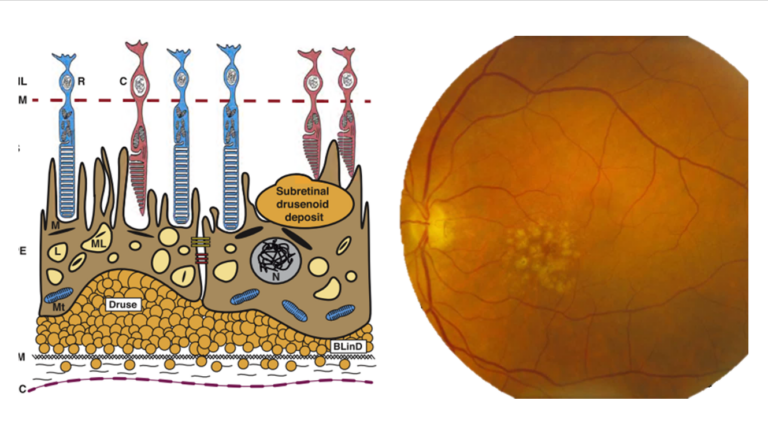 Detección Precoz y Seguimiento de la Degeneración Macular Asociada a la Edad por el Óptico-Optometrista